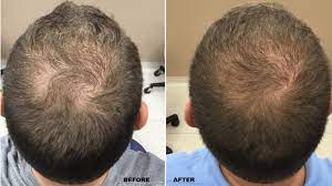 Procedure and Benefits of Smart FUE Hair Transplant