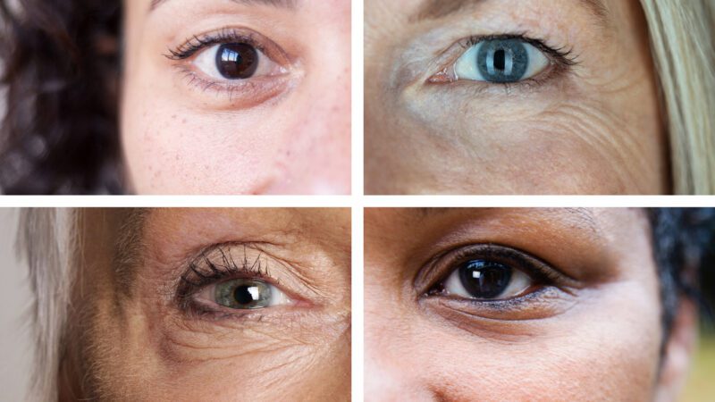 What is the Best Treatment for Bags Under the Eyes? 0 (0)