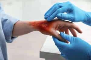 What Legal Options Do Burn Injury Victims Have in Los Angeles?