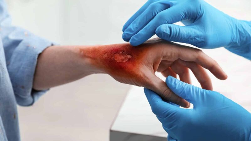 What Legal Options Do Burn Injury Victims Have in Los Angeles? 0 (0)