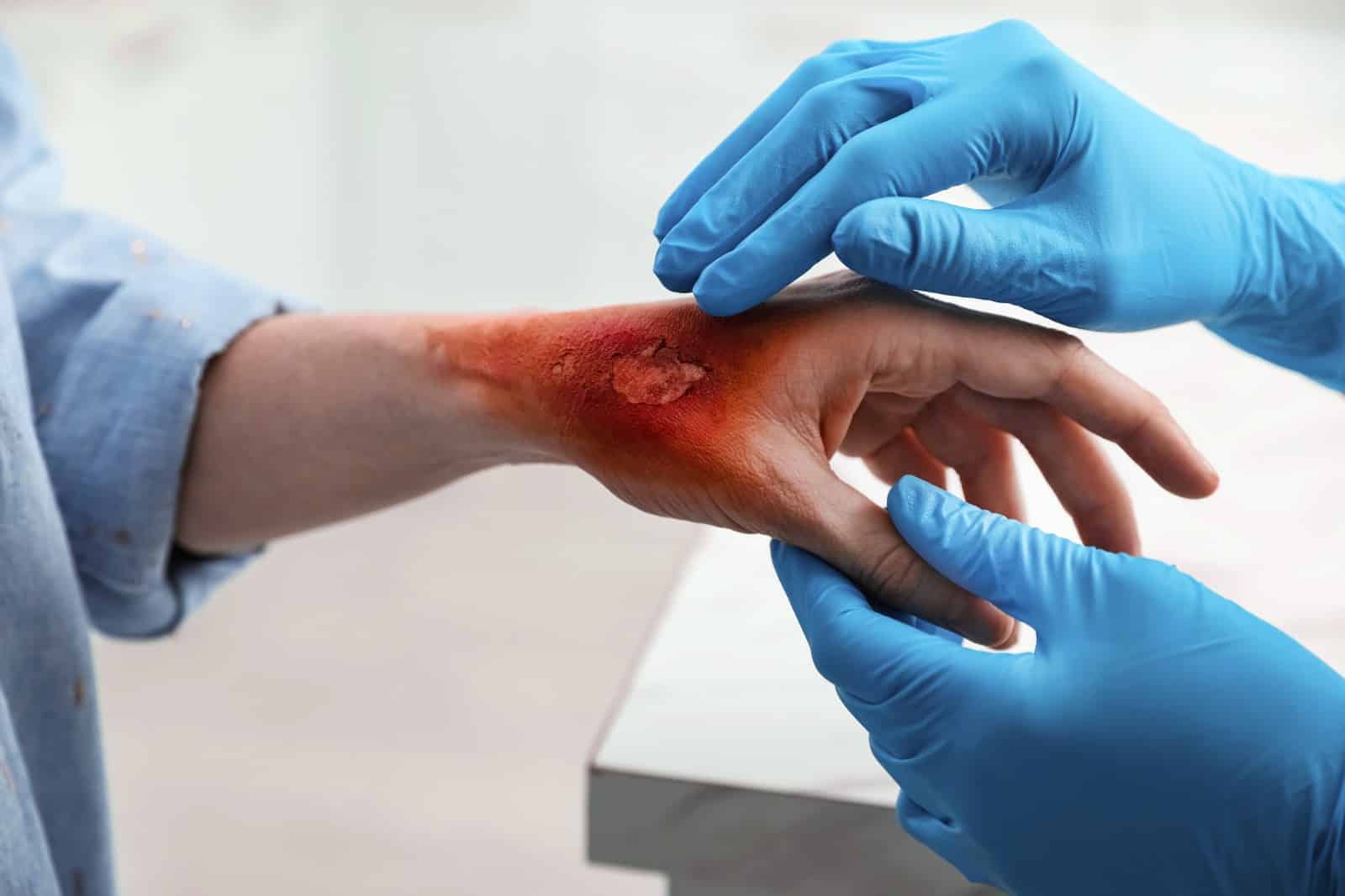 What Legal Options Do Burn Injury Victims Have in Los Angeles?